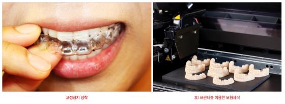 시스루 투명교정, 치아교정의 새로운 패러다임을 제시