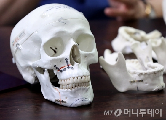 양악수술 환자의 수술후 시뮬레이션 모형/사진=홍봉진 기자