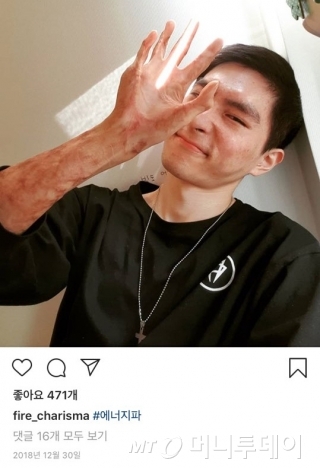 화상흉터가 남아있는 손 사진에 '에너지파'라고 적어놨다. /사진=이찬호씨 인스타그램 캡처