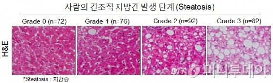 사람의 간조직 지방간 발생단계/사진제공=보건복지부 질병관리본부