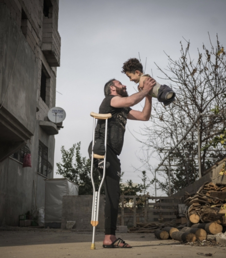 '시리아내전 상징' 다리잃은 아빠·손발 없는 아들, 이탈리아 정착