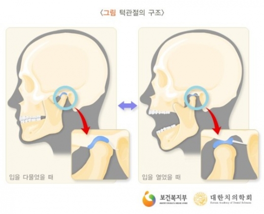 턱 관절 소리 증상…턱뿐만 아니라 관절도 위험할 수 있어 - 머니투데이 뉴스 턱 관절 소리 증상…턱뿐만 아니라 관절도 위험할 수 있어 - 머니투데이 뉴스