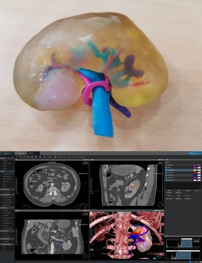(상)환자의 신장암 모형 3D 프린팅 제작물 (하)환자의 신장에 발생한 종양 크기와 위치를 영상으로 확인하는 AVIEW modeler 프로그램/사진제공=(주)코어라인소프트