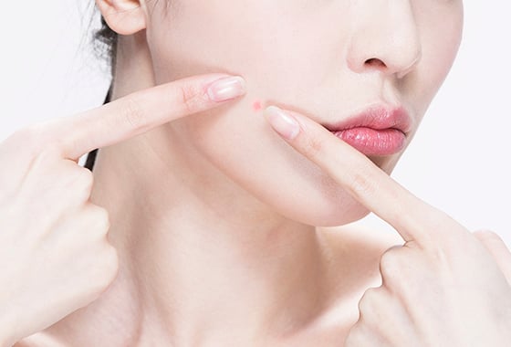 같은 곳에 계속 나는 뾰루지, 왜 이런 거죠? - 머니투데이 같은 곳에 계속 나는 뾰루지, 왜 이런 거죠? - 머니투데이