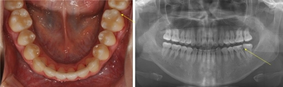 스케일링이 시린 걱정이라면? 10