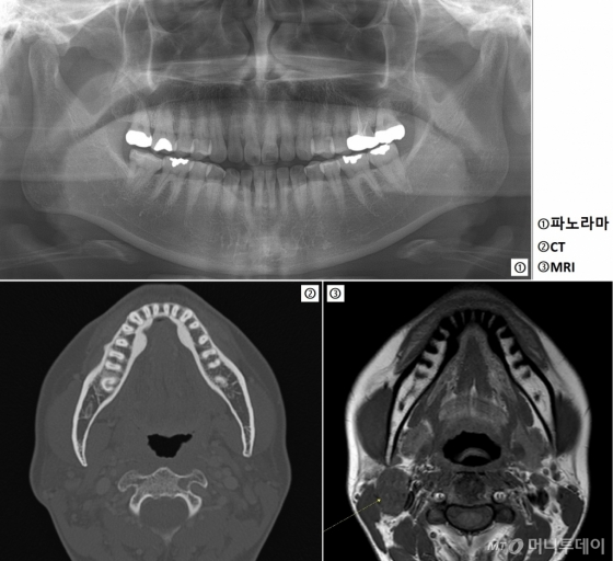 ΰ ؼ  45 ȯ(A) 3 . ĳ() CT(Ʒ ) ߰ߵ ʾҴ  MRI(Ʒ )  (ȭǥ) Ÿ./=ġ