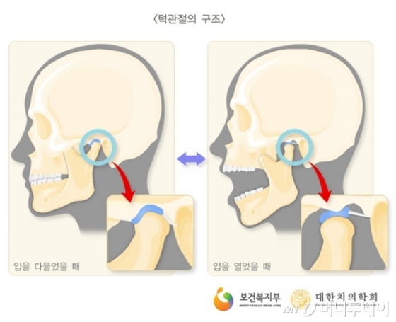 강동 턱관절, 턱관절 장애 치료 "스플린트 vs 보톡스 주사"