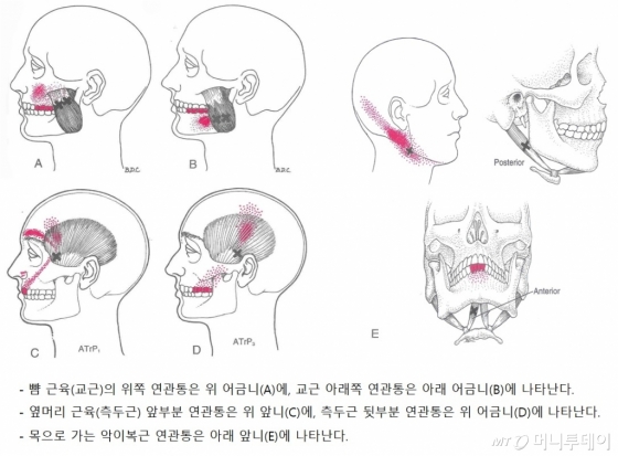 성남 턱관절후기 2편 스플린트 본뜨고 턱에 보톡스 맞고옴(+스플린트 비용, 보톡스 비용은?) 2