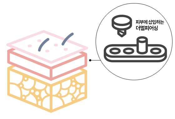 피부에 삽입하는 형태인 더멀 피어싱/일러스트=게티이미지뱅크