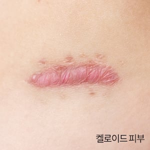 켈로이드 피부/사진=게티이미지뱅크