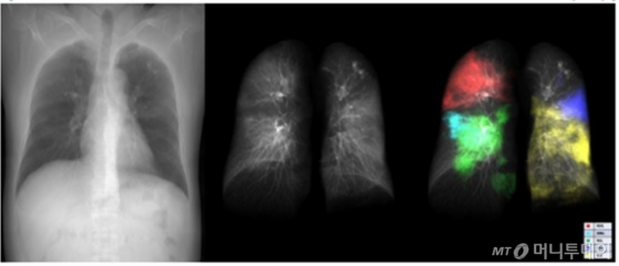 메디컬아이피 의료영상 분석 프로그램을 통해 확인된 코로나19 환자의 폐 병변(우측)/사진제공=메디컬아이피