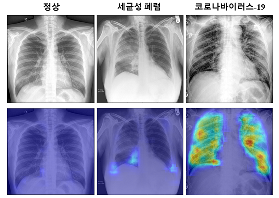 제안하는 코로나19 진단 알고리즘을 통하여 얻은 코로나19 확률 분포 특징 지도의 예. 다른 병변에서는 의심되는 영역이 거의 나타나지 않았으나 코로나19의 경우 고화질로 의심이 되는 부분이 표시되는 것을 볼 수 있다/사진=KAIST