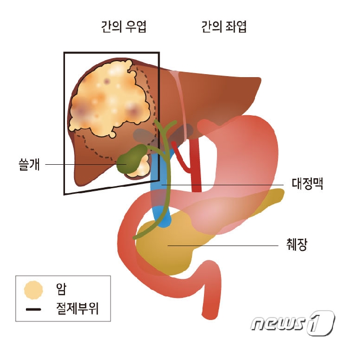 온종합병원 박광민 소화기암수술센터장이 최근 절제한 간암세포 위치. &#40;온종합병원 제공&#41; 2020.8.17 &copy; 뉴스1