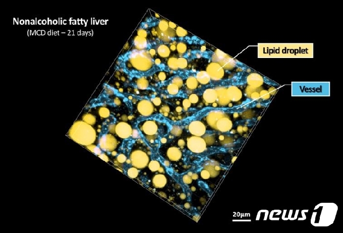 지방간의 3차원 생체현미경 영상 결과© 뉴스1