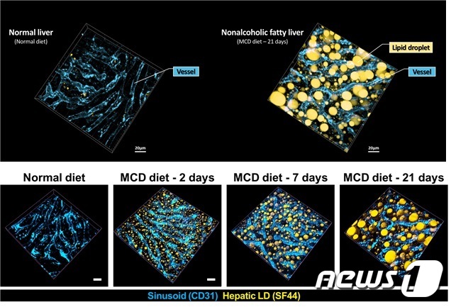 간세포 내 크기가 큰 지방구(Lipid droplet,황색) 형성으로 인한 간세포 핵(*)의 위치변화 및 간세포의 모양 변화(점선)를 보여주는 생체현미경 영상 결과© 뉴스1