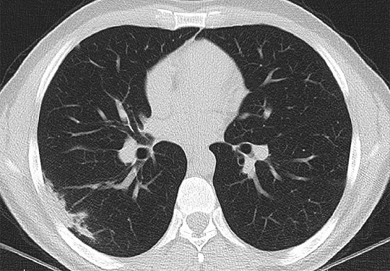 코로나19에 걸려 손상된 폐(불투명한 흰색 패치, 왼쪽 아래)은 초기 감염 후 몇 주 동안 지속된다. Ali Gholamrezanezhad 제공