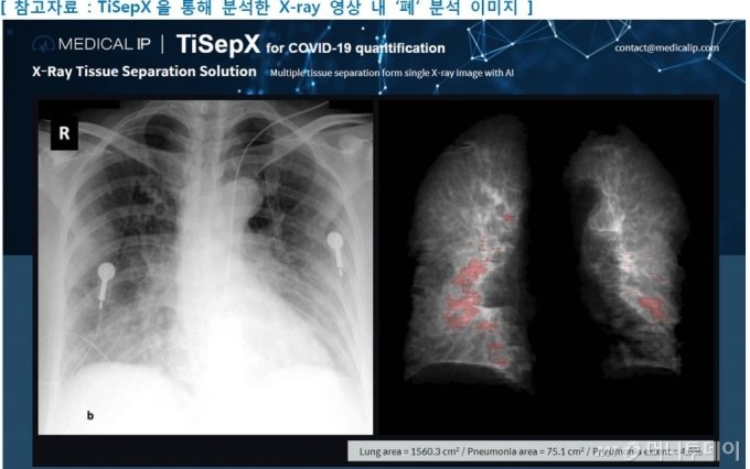 티셉을 통해 분석된 코로나19 환자의 폐 X-레이 사진/사진제공=메디컬아이피