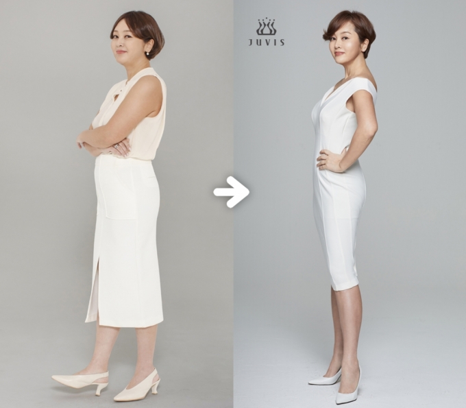갑상선 기능 저하증 다이어트 6개월 7kg 감량