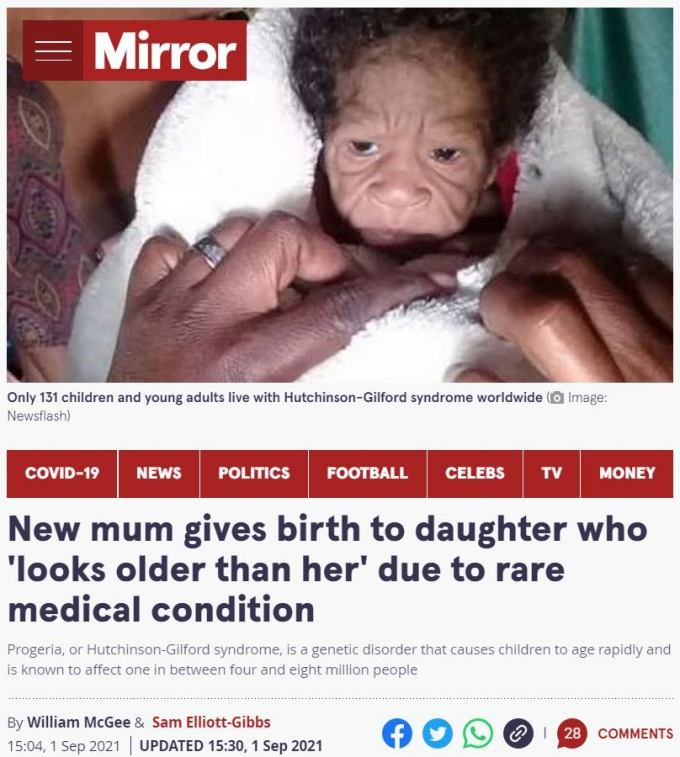 남아프리카공화국에서 노인의 얼굴을 한 아기가 태어났다. /사진=영국 매체 미러 캡처