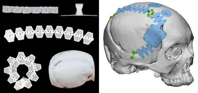 티앤알바이오팹-비브라운 신경외과 수술재료 두개안면골 임플란트 제품(왼쪽)과 적용 예시. /사진제공=티앤알바이오팹