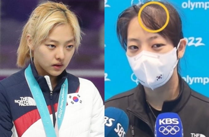 노선영 항소에 스트레스 심했나...김보름, '탈모 우려' 나온 사진 한 장 - 머니투데이 노선영 항소에 스트레스 심했나...김보름, '탈모 우려' 나온 사진 한 장 - 머니투데이