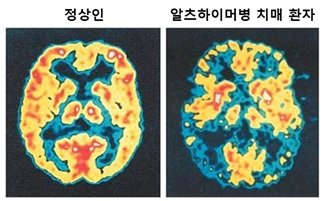양전자방출단층촬영술(Positron Emission Tomography; PET)을 통해 정상인 및 알츠하이머병 치매환자의 뇌를 비교한 자료. (자료=Alzheimer’s Disease Education And Referral Center, National Institute On Aging, 셀리버리)