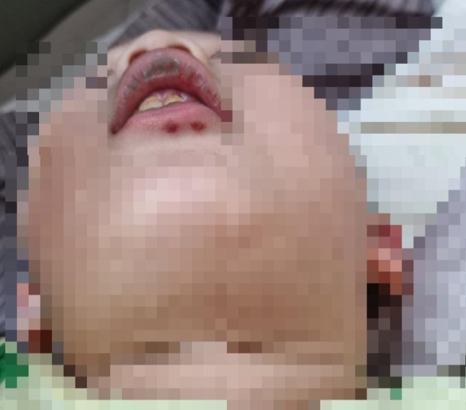 지난달 13일 서울 서대문구 한 어린이집에서 원아(2)가 부딪힘 사고로 이빨이 함몰됐다./사진=보배드림