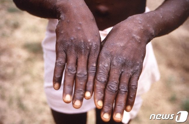 미국 질병통제예방센터가 제공한 콩고민주공화국에서 1997년 촬영한 원숭이두창 감염자의 손 사진. (C) AFP=뉴스1 (C) News1 정윤미 기자