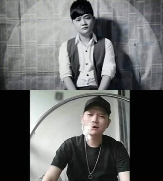 빈랑 섭취로 구강암을 앓다가 세상을 떠난 중국 가수 보송/사진=트위터