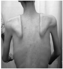 근위축성 이영양증(Myotonic Dystrophy Type 1)에 의해 호흡근과 전신근육이 결함 된 환자. /사진제공=셀리버리