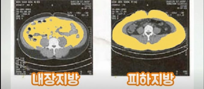 CT를 통해 나타난 복부지방. /사진=유튜브 캡처