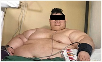 고도비만환자/사진제공=셀리버리