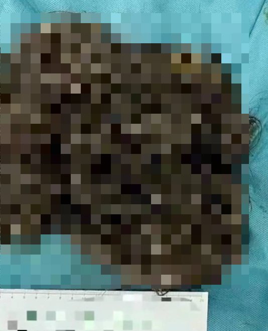 중국 14세 소녀의 배에서 발견된 3㎏ 머리카락 뭉치/사진=SCMP