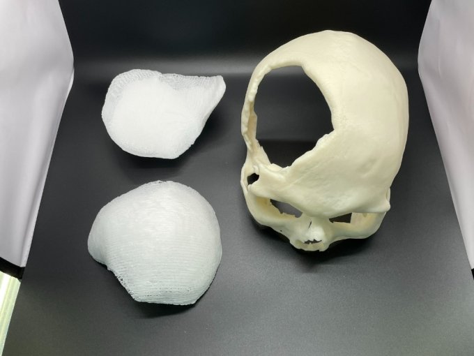 티앤알바이오팹이 우크라이나 환자의 두개골을 재건하기 위해 제작한 스캐폴드(PSI, Patient Specific Implant) 관련 사진. /사진제공=티앤알바이오팹 