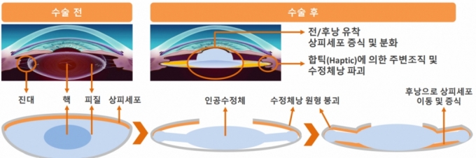 백내장 수술 후 초점 안맞아요