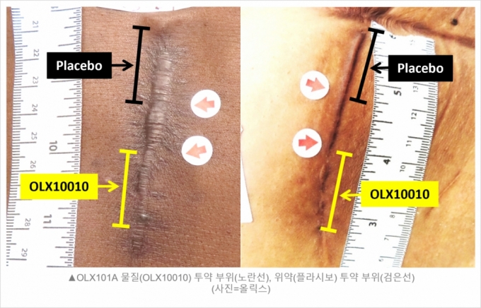 올릭스, '비대흉터 치료제' 美 임상 2a상에서 효력 확인