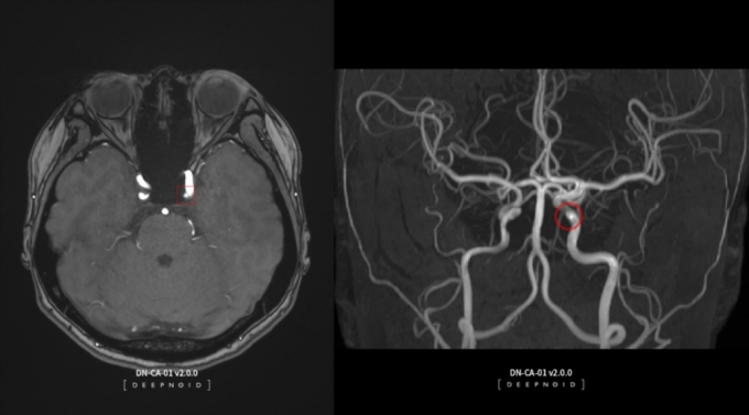 최근 한국보건의료연구원으로부터 혁신의료기술로 선정된 딥노이드의 '딥뉴로'(DEEP:NEURO) 영상 / 사진제공=딥노이드