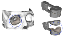 CT 영상을 기반으로 수술 전, 3D 프린터로 출력한 환자 맞춤형 임플란트 가이드. / 사진=건국대병원
