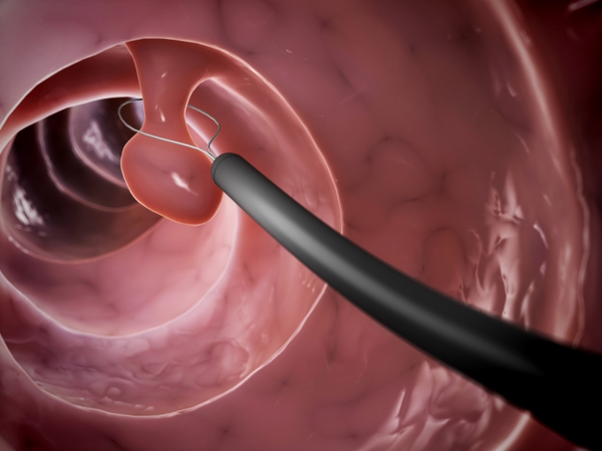 대장 내시경은 5년에 한 번?…"이럴 땐 내년에 또 받아야"