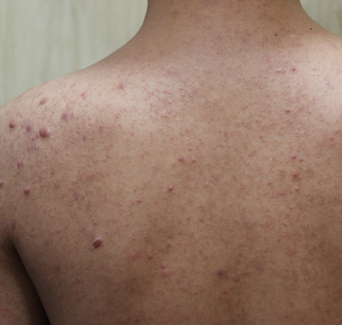 Understanding Keloid Acne Scars: Causes, Treatment, and Prevention