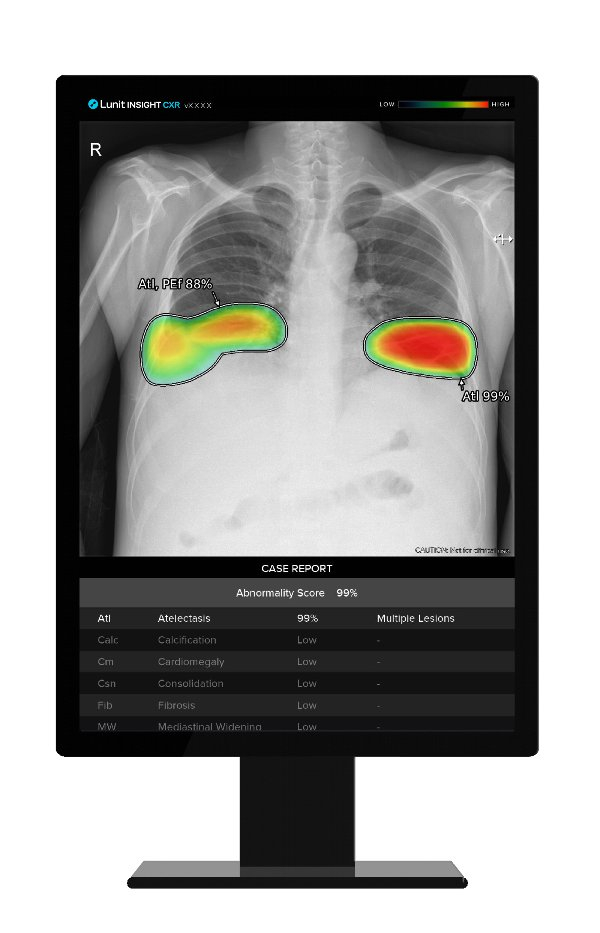 루닛 인사이트 CXR /사진=루닛