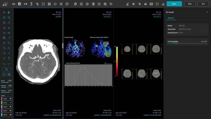대뇌혈관폐색 조기검출 솔루션 'JBS-LVO' 화면./사진=제이엘케이