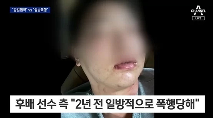 전 야구선수 임혜동이 야구선수 김하성에게 폭행당했다며 사진을 공개했으나 김하성 측은 임혜동이 과거 가정 폭력을 당했을 때 찍은 사진이라는 의혹이 제기됐다../사진=채널A