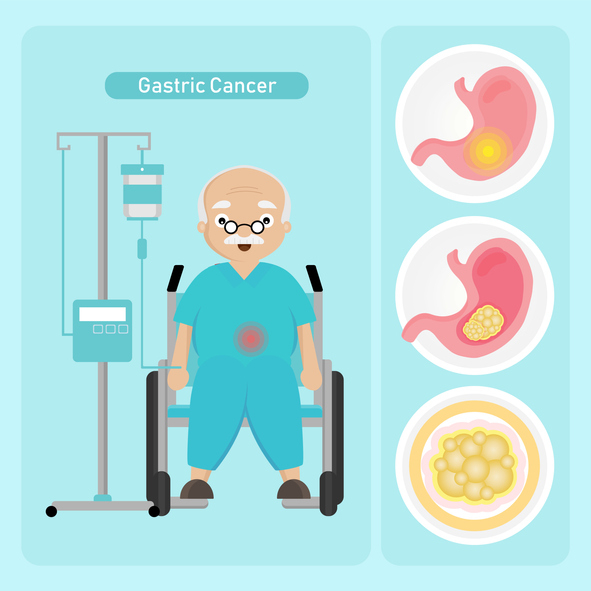 나이 많아서 '위암 수술' 포기?…생존율 영향 미치는 4가지