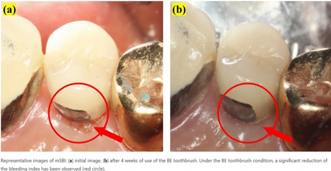 생체전류 칫솔 '트로마츠', 임플란트 부작용도 예방...출혈지수 개선