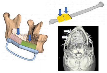 디지털 프로그램과 3D 프린팅 기술을 이용해 광범위한 구강암 수술 후 턱뼈를 정교하게 재건한 모습./사진=서울대병원