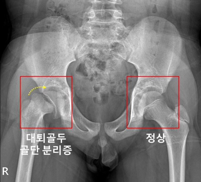  오른쪽 고관절에 대퇴골두 골단 분리증이 발생한 소아청소년 환자의 X-선 사진. /사진=서울대병원 