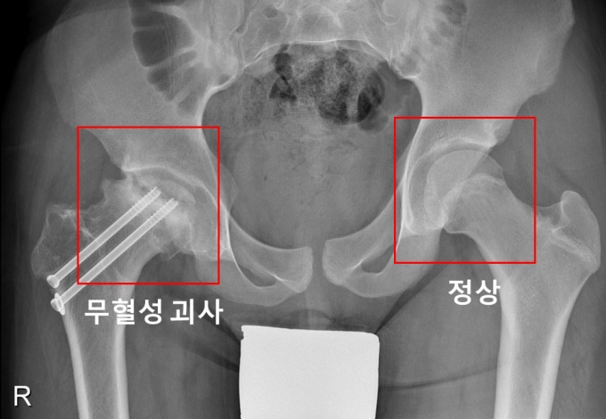 오른쪽 고관절에 무혈성 괴사가 발생한 소아청소년 환자의 X-선. /사진=서울대병원