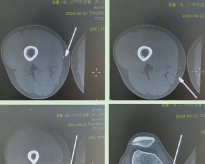 허벅지에 금속 파편이 박힌 한 중국 남성이 아이언맨을 따라하려다 응급 수술을 받았다./사진=SCMP 캡쳐