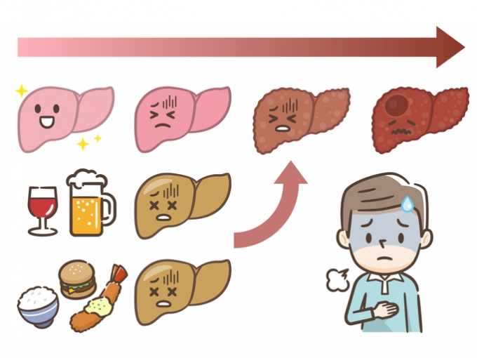 술도 안 마시는데 찾아온 지방간…○○○암 위험 '4.7배'